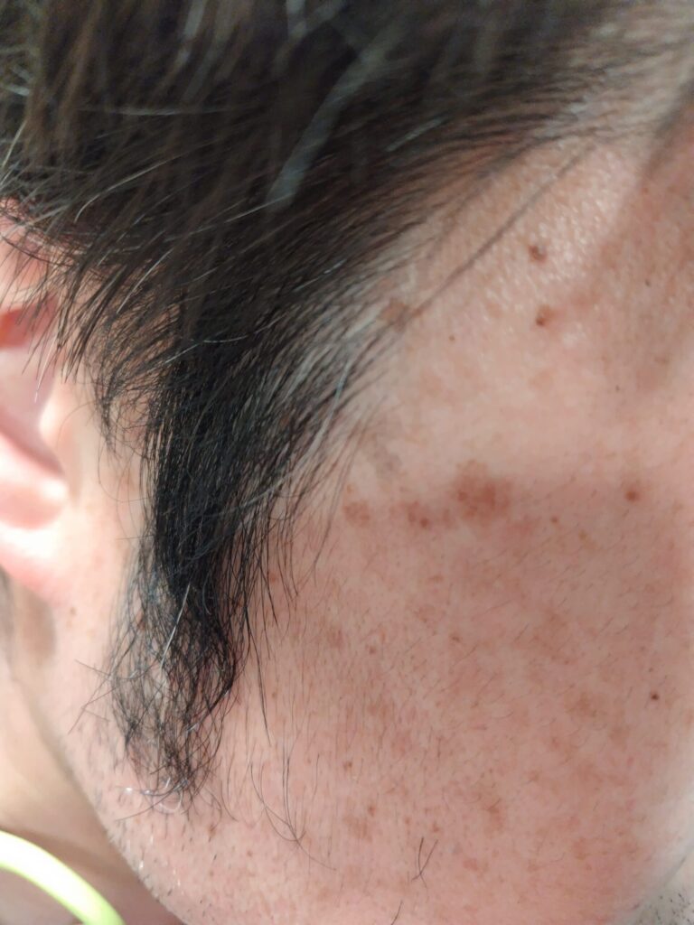 頬ともみあげ周辺を写した写真で、肌に複数の濃いシミやそばかすが見え、もみあげの毛がまばらに生えている様子がわかる構図。