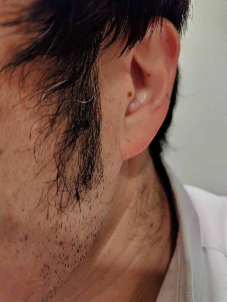 耳ともみあげ周辺を横から捉えたクローズアップで、短いひげの stubble と肌の質感、ほくろや毛の生え際が見える構図。