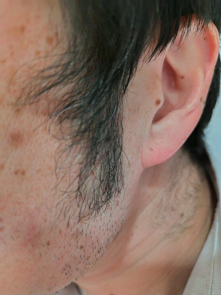頬から耳ともみあげ周辺を横から写した写真で、短いひげの stubble と肌のシミやほくろ、毛の生え際の状態がわかるクローズアップ。